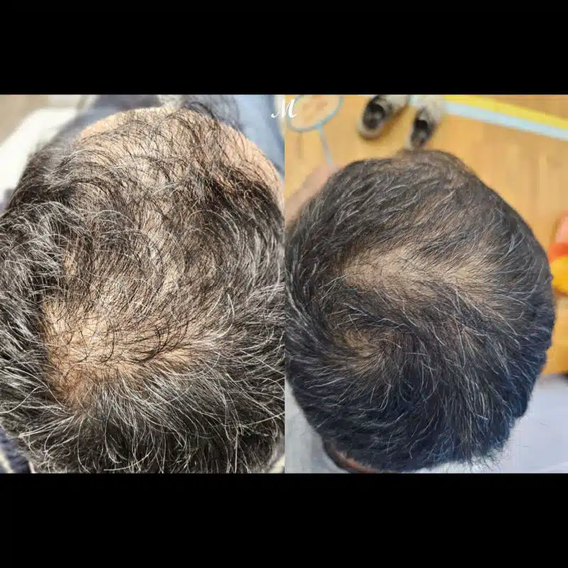 Hair Transplant Results - Before and After - Case 1